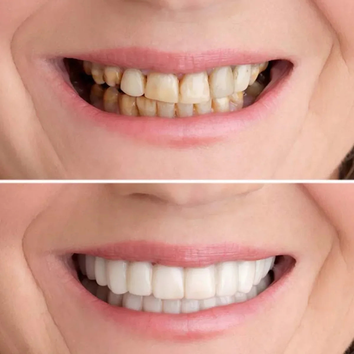 SMILEPRO® – Zâmbet perfect instantaneu – Ofertă exclusivă 2 la preț de 1