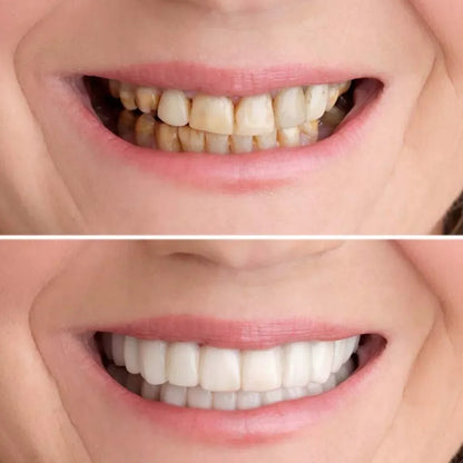 SMILEPRO® – Zâmbet perfect instantaneu – Ofertă exclusivă 2 la preț de 1